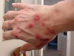 Helminthiasis ile ciltte papüller